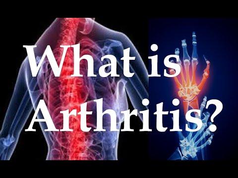 Arthritis